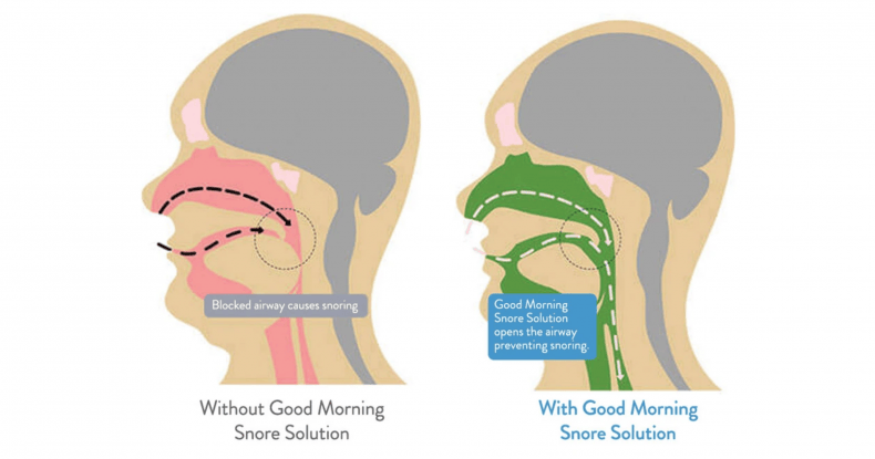 Good Morning Snore Solution review